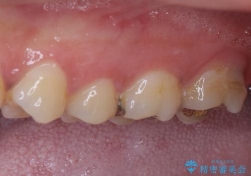 何度も外れてしまう銀歯　ゴールドインレーによる虫歯治療の治療後