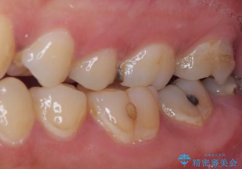 何度も外れてしまう銀歯　ゴールドインレーによる虫歯治療の治療後