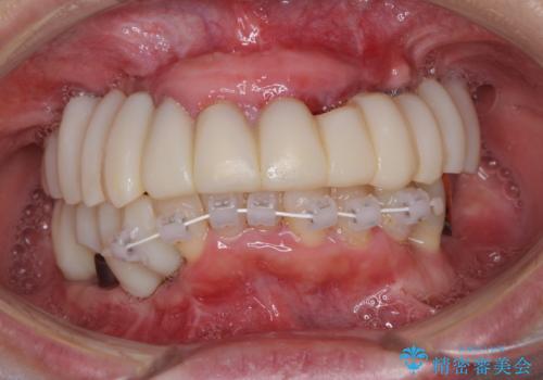 歯周病で痛い 全顎的歯周病治療の治療中