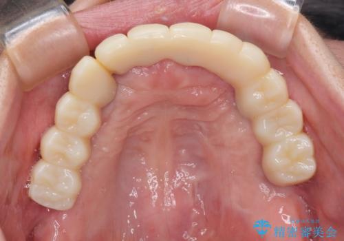 歯周病で痛い 全顎的歯周病治療の治療中