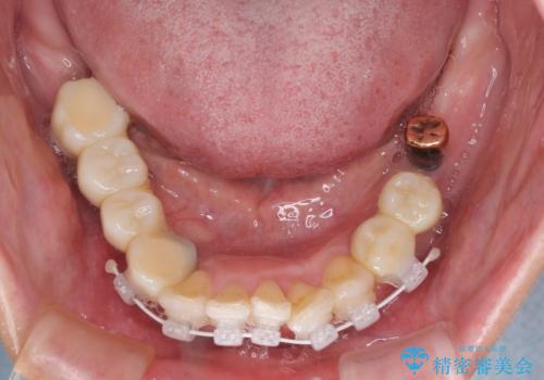 歯周病で痛い 全顎的歯周病治療の治療中