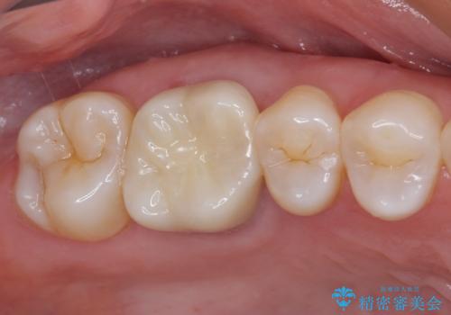 指摘された虫歯 オールセラミッククラウンによる補綴治療の治療後