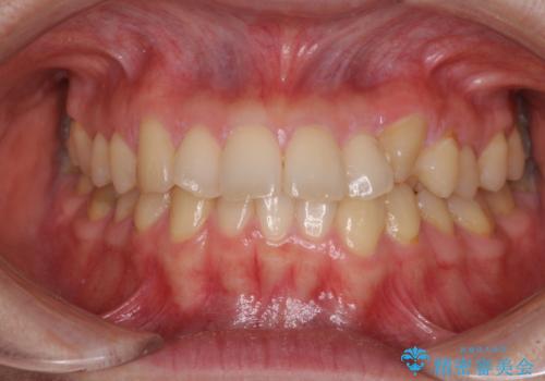 【モニター】1本欠損した下顎前歯と上顎の八重歯 ワイヤー装置で楽して矯正治療の症例 治療前