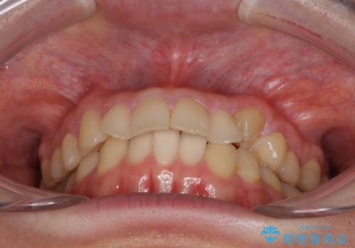 【モニター】1本欠損した下顎前歯と上顎の八重歯 ワイヤー装置で楽して矯正治療の治療前