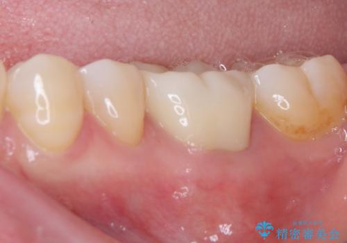 指摘された虫歯 オールセラミッククラウンによる補綴治療の治療後
