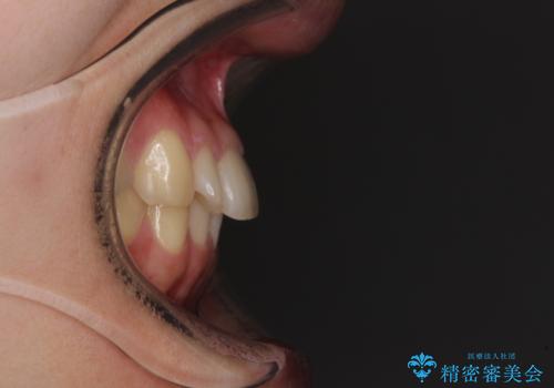 【モニター】1本欠損した下顎前歯と上顎の八重歯 ワイヤー装置で楽して矯正治療の治療前