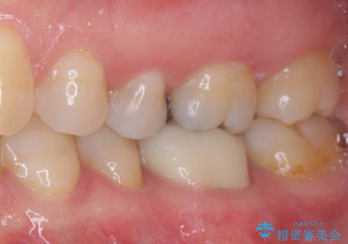 指摘された虫歯 オールセラミッククラウンによる補綴治療の治療後