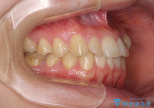 【モニター】1本欠損した下顎前歯と上顎の八重歯 ワイヤー装置で楽して矯正治療の治療前