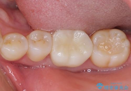 指摘された虫歯 オールセラミッククラウンによる補綴治療の治療後