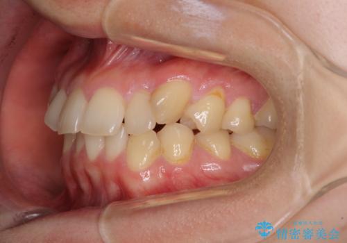 【モニター】1本欠損した下顎前歯と上顎の八重歯 ワイヤー装置で楽して矯正治療の治療前