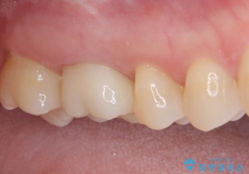 指摘された虫歯 オールセラミッククラウンによる補綴治療の治療後