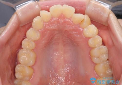 【モニター】1本欠損した下顎前歯と上顎の八重歯 ワイヤー装置で楽して矯正治療の治療前