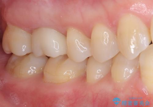 指摘された虫歯 オールセラミッククラウンによる補綴治療の治療後