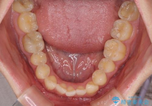 【モニター】1本欠損した下顎前歯と上顎の八重歯 ワイヤー装置で楽して矯正治療の治療前