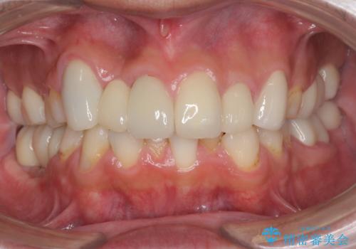 短期間で歯並びをきれいにしたい セラミックでかぶせる治療でも良い