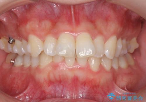 前歯をさげたい 歯を抜かずに マウスピース矯正で治したいの治療中