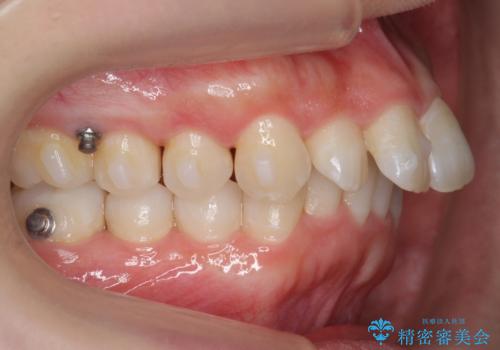 前歯をさげたい 歯を抜かずに マウスピース矯正で治したいの治療中