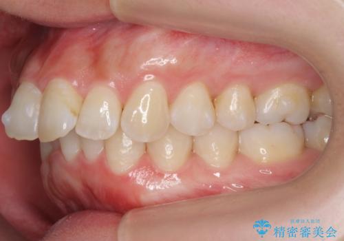 前歯をさげたい 歯を抜かずに マウスピース矯正で治したいの治療中