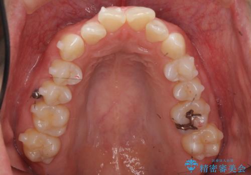前歯をさげたい 歯を抜かずに マウスピース矯正で治したいの治療中