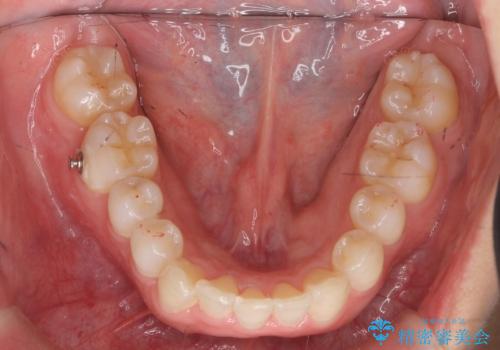 前歯をさげたい 歯を抜かずに マウスピース矯正で治したいの治療中