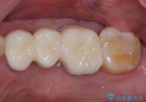 ものが挟まって痛む 割れてしまった歯のオールセラミックブリッジ治療の症例 治療後