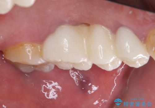 ものが挟まって痛む 割れてしまった歯のオールセラミックブリッジ治療の治療後