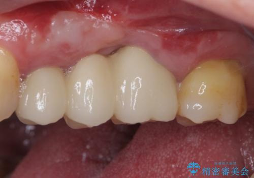 ものが挟まって痛む 割れてしまった歯のオールセラミックブリッジ治療の治療後
