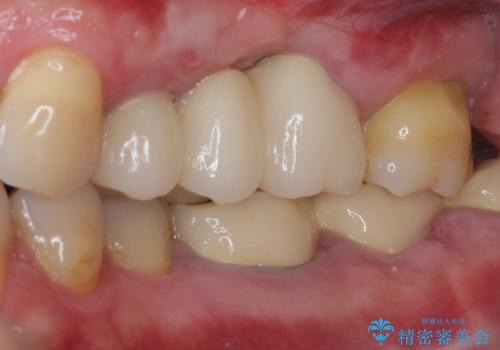 ものが挟まって痛む 割れてしまった歯のオールセラミックブリッジ治療の治療後