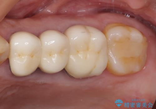 ものが挟まって痛む 割れてしまった歯のオールセラミックブリッジ治療の症例 治療前