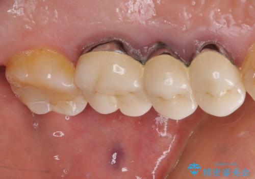 ものが挟まって痛む 割れてしまった歯のオールセラミックブリッジ治療の治療前