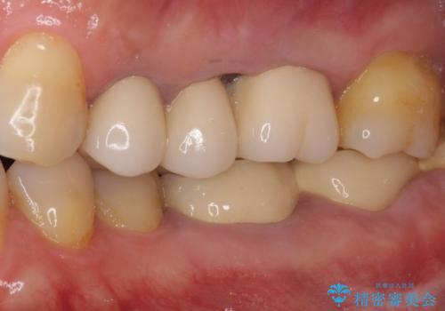 ものが挟まって痛む 割れてしまった歯のオールセラミックブリッジ治療の治療前