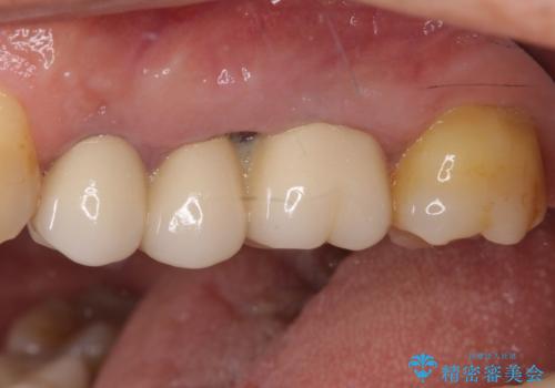 ものが挟まって痛む 割れてしまった歯のオールセラミックブリッジ治療の治療前