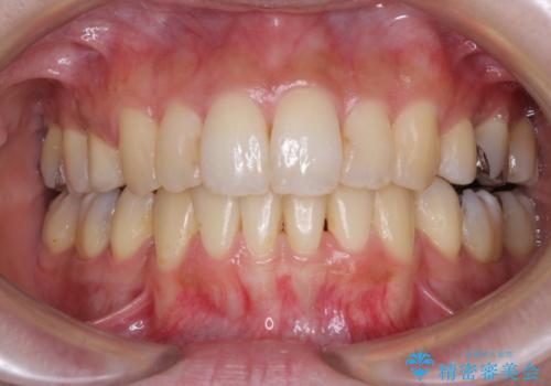 後戻りで突出した前歯をインビザラインで解消の症例 治療後