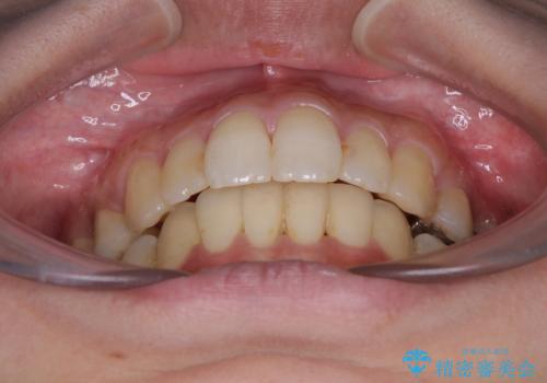 後戻りで突出した前歯をインビザラインで解消の治療後