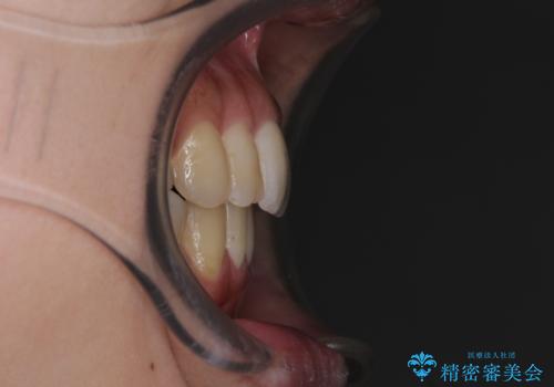 後戻りで突出した前歯をインビザラインで解消の治療後