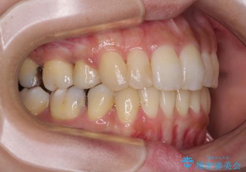 後戻りで突出した前歯をインビザラインで解消の治療後