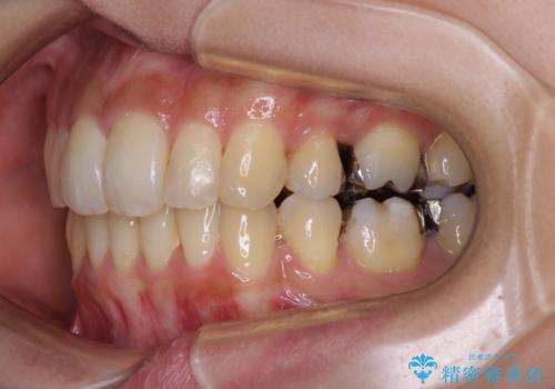 後戻りで突出した前歯をインビザラインで解消の治療後