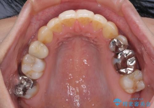 後戻りで突出した前歯をインビザラインで解消の治療後
