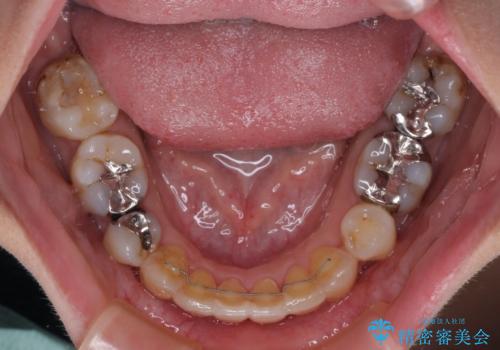 後戻りで突出した前歯をインビザラインで解消の治療後