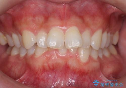 前歯をさげたい 歯を抜かずに マウスピース矯正で治したいの症例 治療前