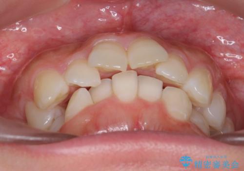 前歯をさげたい 歯を抜かずに マウスピース矯正で治したいの治療前