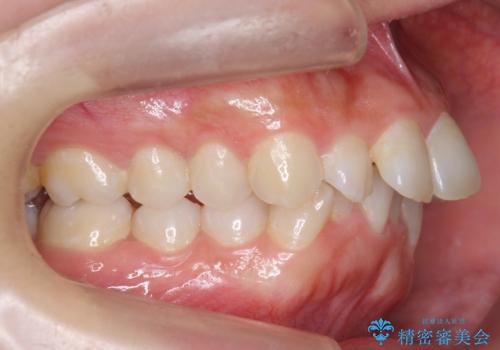 前歯をさげたい 歯を抜かずに マウスピース矯正で治したいの治療前