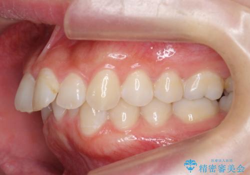 前歯をさげたい 歯を抜かずに マウスピース矯正で治したいの治療前