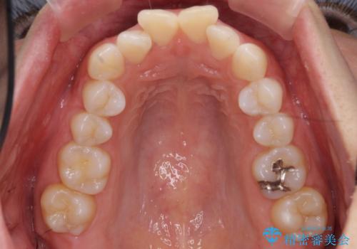 前歯をさげたい 歯を抜かずに マウスピース矯正で治したいの治療前