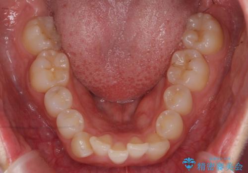 前歯をさげたい 歯を抜かずに マウスピース矯正で治したいの治療前