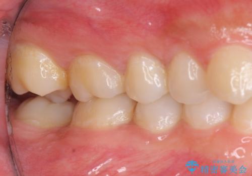 前歯をさげたい 歯を抜かずに マウスピース矯正で治したいの治療前