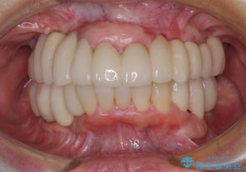 歯周病で痛い 全顎的歯周病治療の症例 治療後