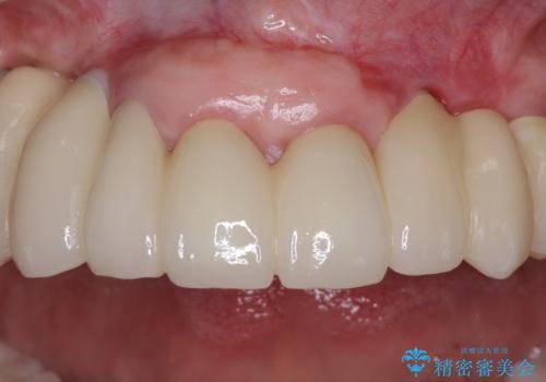 歯周病で痛い 全顎的歯周病治療の治療後