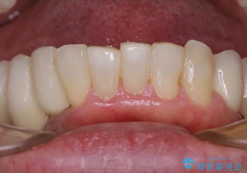 歯周病で痛い　全顎的歯周病治療の治療後