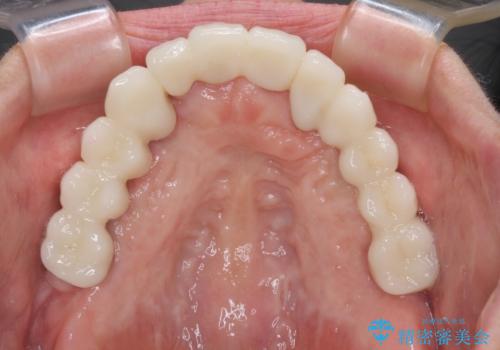 歯周病で痛い 全顎的歯周病治療の治療後